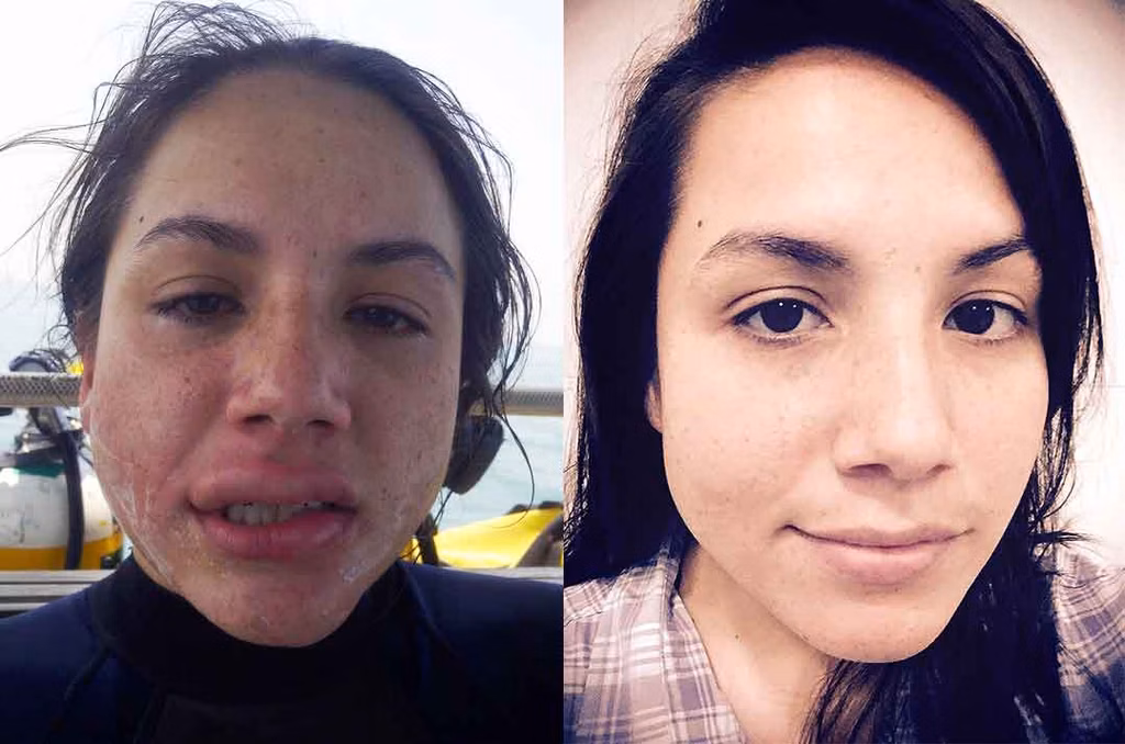Jellyfish Sting Before and After